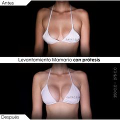 Levantamiento mamario con prótesis - Dr. Juan Canencio