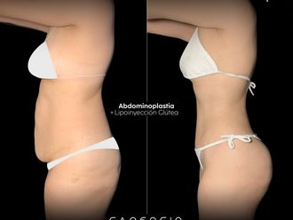 Abdominoplastia antes y después - 870534