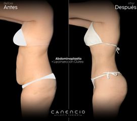 Abdominoplastia + Lipoinyección glútea - Dr. Juan Canencio