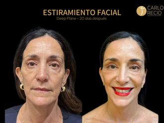Lifting facial antes y después - 879581