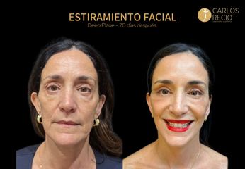 Lifting facial