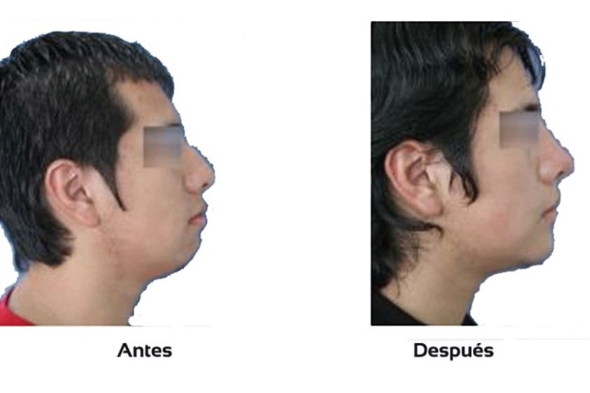 Mentoplastia antes y después - 509794