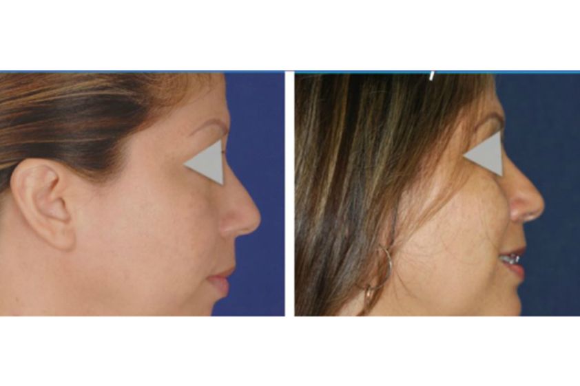 Mentoplastia antes y después - 624926