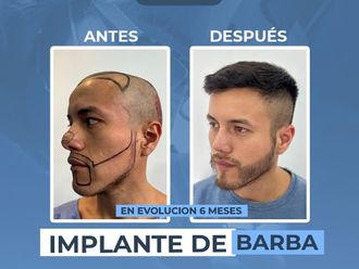 Trasplantes capilares antes y después - 881281