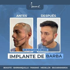 Transplantes capilares - Innovart Medical IPS