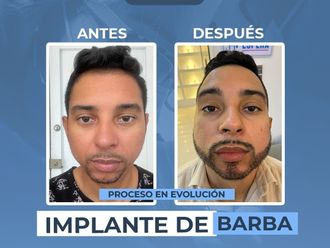 Trasplantes capilares antes y después - 881282