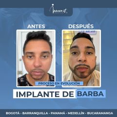 Transplantes capilares - Innovart Medical IPS