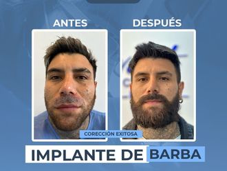 Implantes de cabello antes y después - 881286