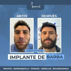 Implante de Barba - Innovart Medical IPS