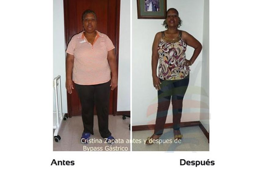 Bypass Gástrico antes y después - 510611