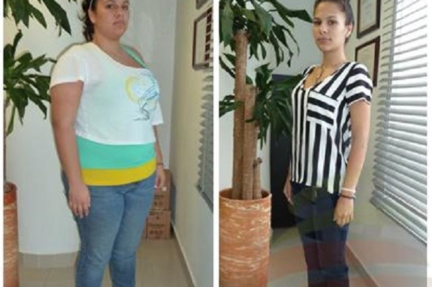 Bypass Gástrico antes y después - 580704