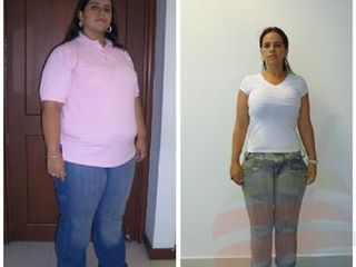 Bypass gastrico