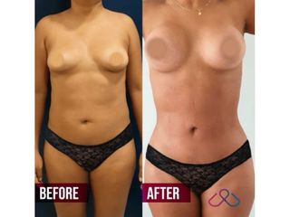 Mamoplastia de aumento