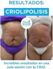 Criolipólisis - Patricia de Lavalle