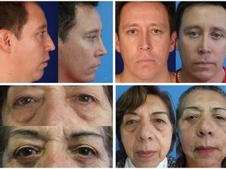 Blefaroplastia
