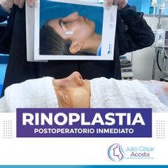 Rinoplastia - Dr. Julio César Acosta
