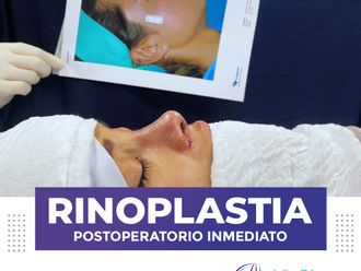 Rinoplastia - 814683