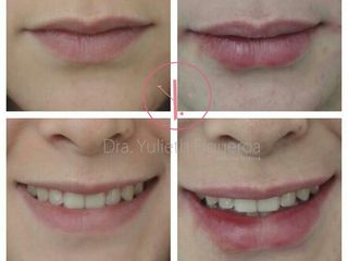 Resultados de Acido hialuronico en labios