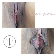 Labioplastia - Dra. Yulieth Figueroa Peñaranda