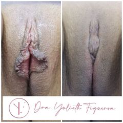 Labioplastia - Dra. Yulieth Figueroa Peñaranda