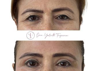 Blefaroplastia antes y después - 877251