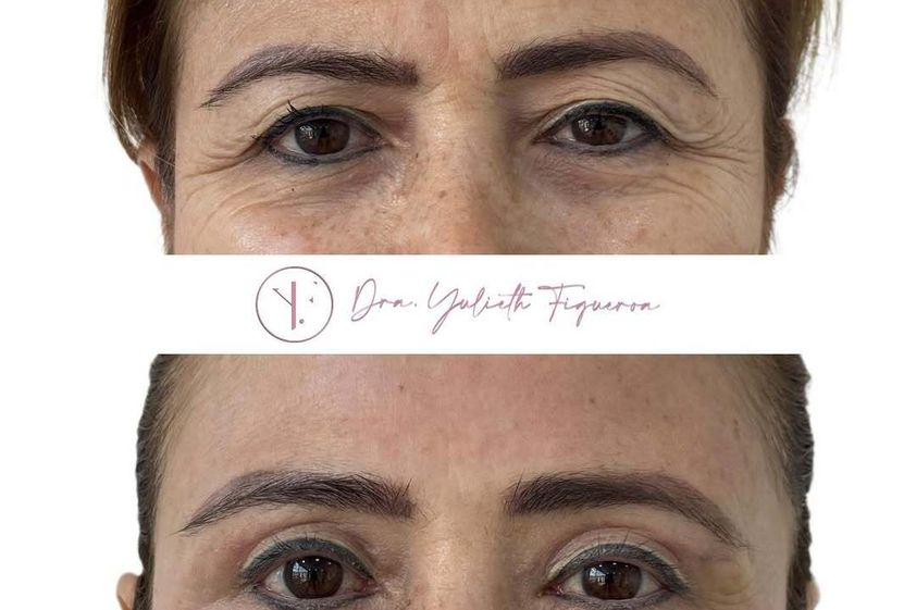 Blefaroplastia antes y después - 877251