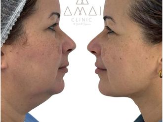 Rejuvenecimiento facial antes y después - 877253