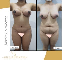 Lipoescultura - Angeles Esmeral
