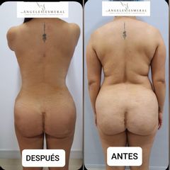 Lipoescultura - Angeles Esmeral
