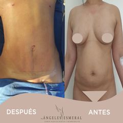 Liposucción - Angeles Esmeral