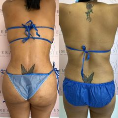 Lipo Abdominoplastia - Dra. Ángeles Esmeral
