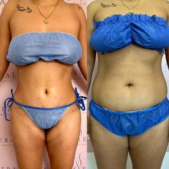 Lipo Abdominoplastia - Dra. Ángeles Esmeral