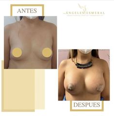 Mamoplastia de aumento - Dra. Ángeles Esmeral