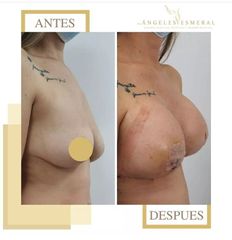 Mastopexia con implantes - Dra. Ángeles Esmeral