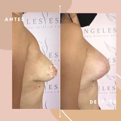 Levantamiento de senos - Dra. Ángeles Esmeral