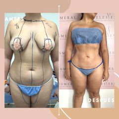 Lipoescultura - Dra. Ángeles Esmeral