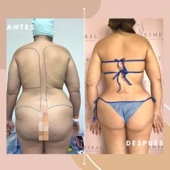 Liposucción - Dra. Ángeles Esmeral