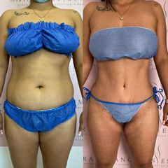 Lipo Abdominoplastia - Dra. Ángeles Esmeral