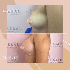 Mamoplastia de aumento - Dra. Ángeles Esmeral