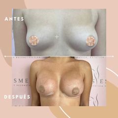 Mamoplastia de aumento - Dra. Ángeles Esmeral
