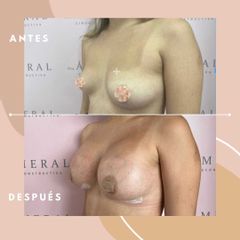 Mamoplastia de aumento - Dra. Ángeles Esmeral