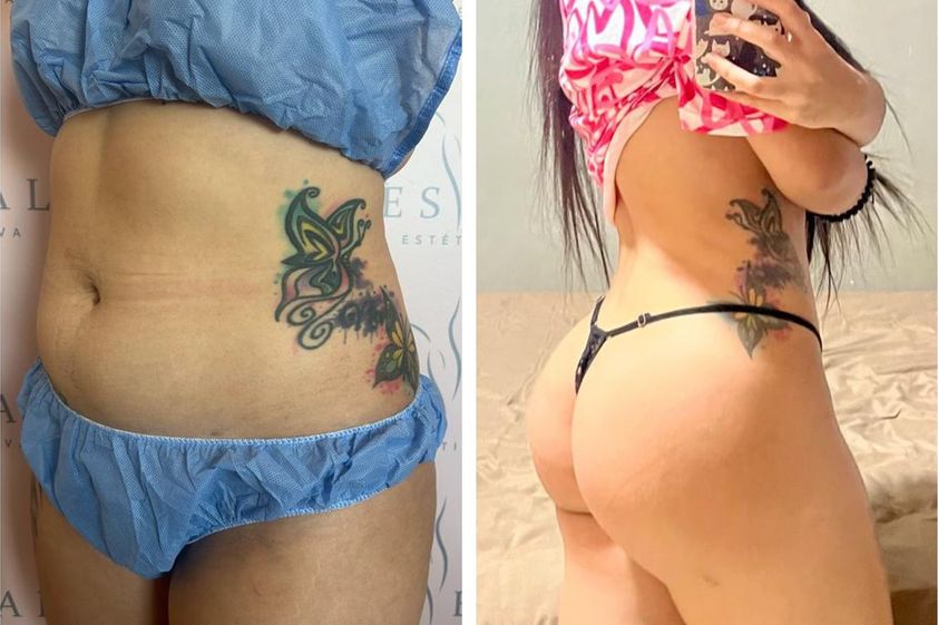 Lipólisis láser antes y después - 867725