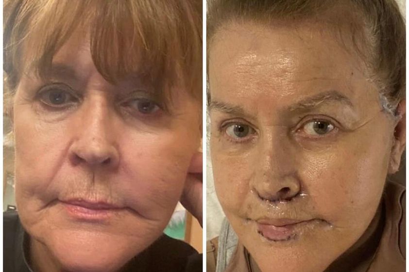 Lifting facial antes y después - 874015