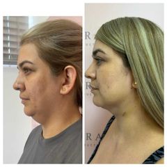 Cirugia de Papada - Dra. Ángeles Esmeral