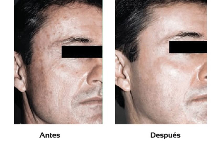 Peeling antes y después - 511066