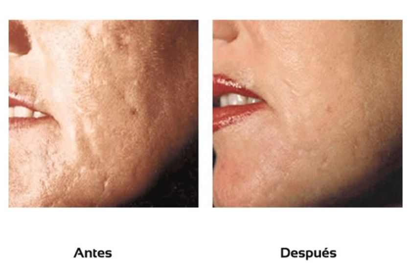 Microdermoabrasión antes y después - 511086
