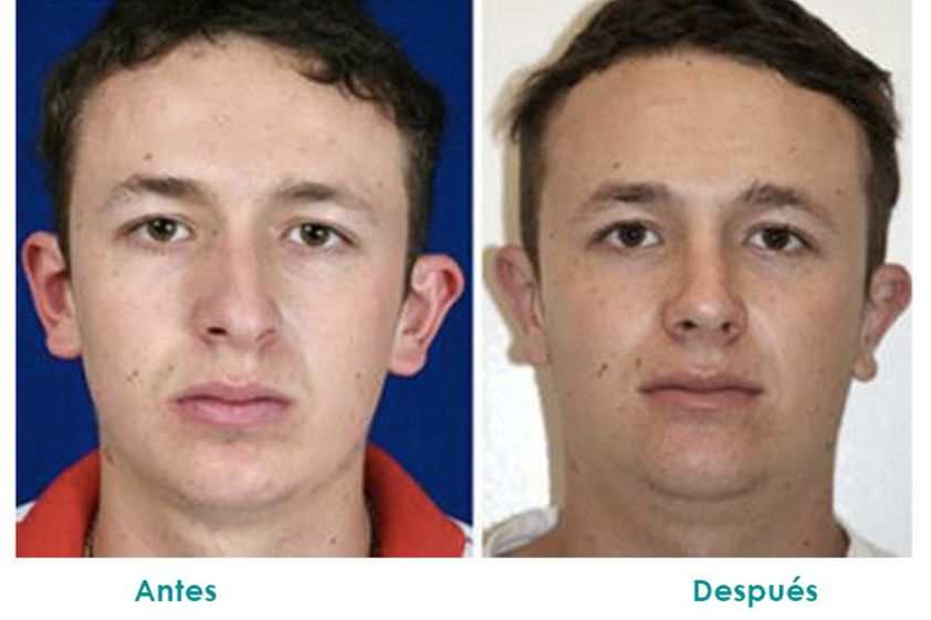 Otoplastia antes y después - 516202