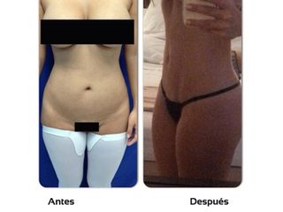Abdominoplastia