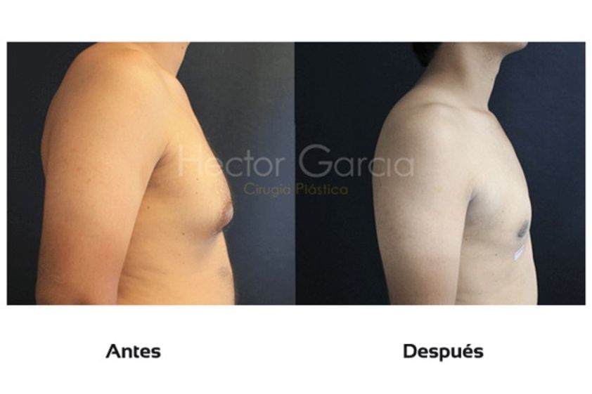 Ginecomastia antes y después - 511630