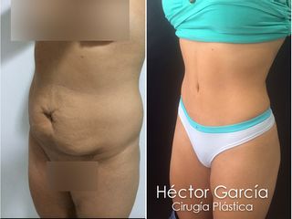 Dr Héctor García Cirugía Plástica